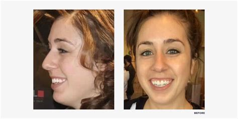 I Got Double Jaw Surgery See My Before And After Photos Realself News