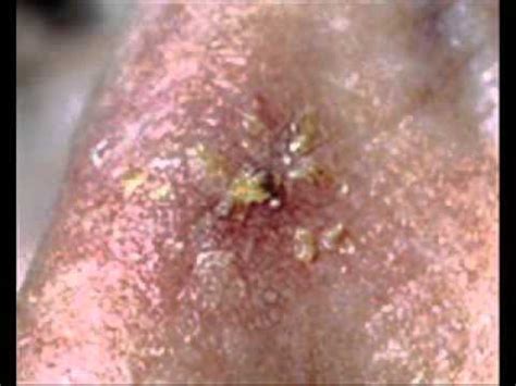 It feels like something is crawling on, stinging, or biting you. Types of Skin Diseases.wmv - YouTube