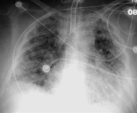 Pulmonary Vascular Disease Radiology Key