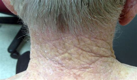 Derm Dx Exaggerated Skin Markings On The Posterior Neck Clinical Advisor