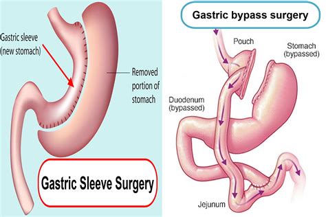 Insanely Gastric Bypass Vs Sleeve Weight Loss Surgery Best Product Reviews