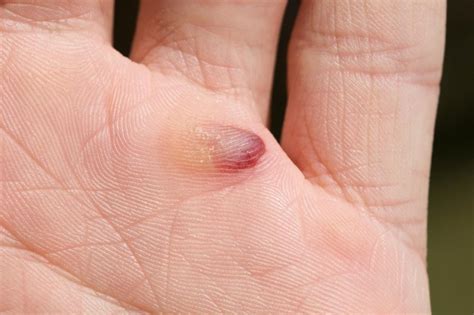 Blood Blisters Causes Diagnosis And Treatment