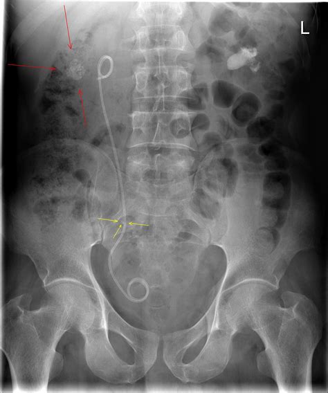 Ureteric Stent