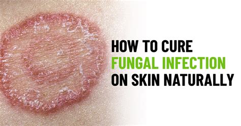 How To Cure Fungal Infection On Skin Naturally Healthyguruz
