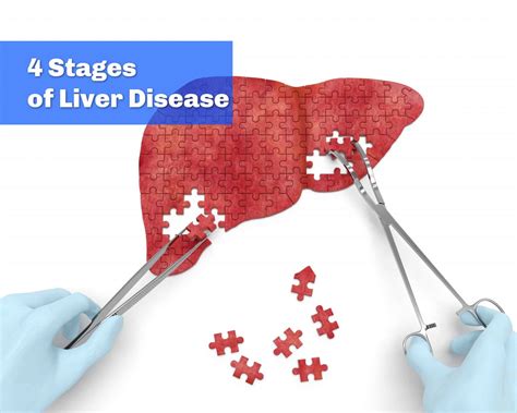 What Are The Four Stages Of Liver Disease Walkin Lab
