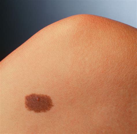 Pigmented Naevus Benign Mole On A Womans Knee Photograph By Phil Jude