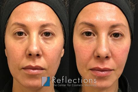 1cc Restylane For Under Eyes Instant Results Before And After Photos