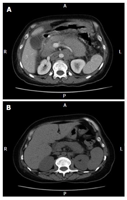 Secondary Pancreatic Involvement By A Diffuse Large B Cell Lymphoma