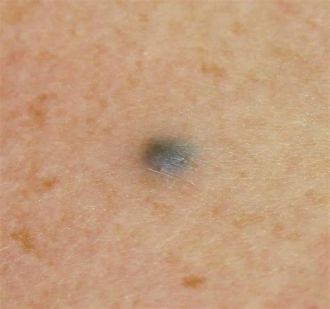 Types Of Moles On The Body