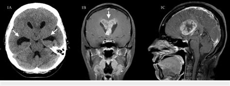 Ct Head Without Contrast And Post Contrast T1 Weight Mri Brain Showing