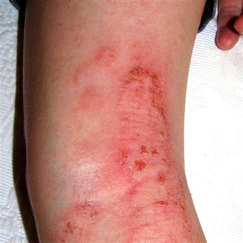 How To Get Rid Of Infantigo Ehow Home Remedies For Eczema Eczema