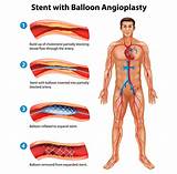 Images of A Balloon Angioplasty Is Used To