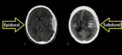 It carries a poor prognosis, not because of the subdural blood itself but because it is very often associated with an underlying parenchymal injury. 10 Vascular Events at Ross University School of Medicine ...