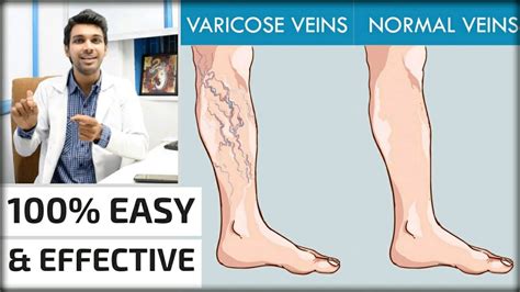 Varicose Vein Treatment At Home In Hindi How To Get Relief From