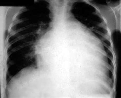 Chest X Ray In A Child With Dilated Cardiomyopathy Open I