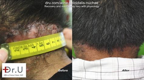Akn Itchy Bumps On Back Of Head Removed With Advanced Surgical