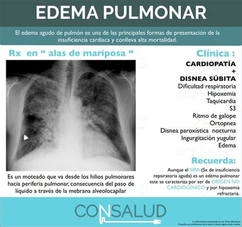 Edema Agudo Pulmonar Flashcards Quizlet