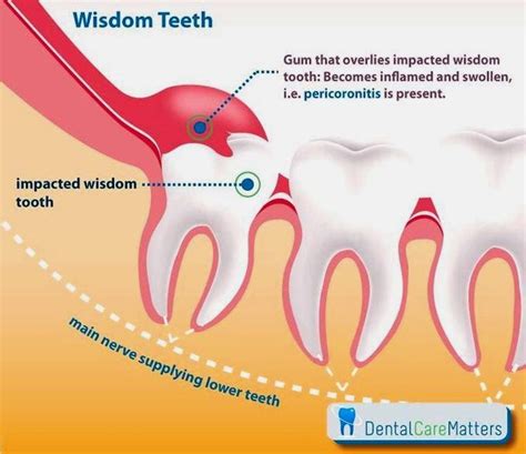 Wisdom Teeth Consultorio Implantes Dentales Exodoncia Y Exodoncia