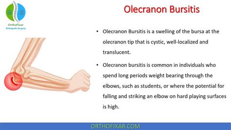 Olecranon Bursitis Or Student Elbow Is A Swelling Of The Bursa At The