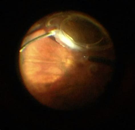 Pars Plana Vitrectomy Eyewiki