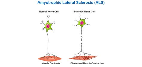 Schematic Diagram Showing The Effects Of Amyotrophic Lateral Sclerosis