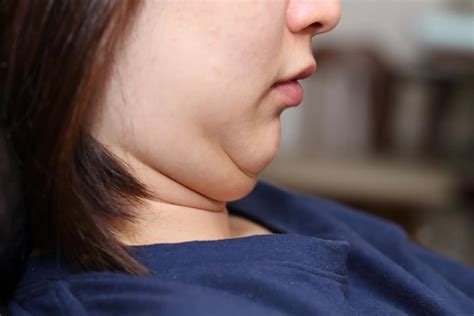 How To Get Rid Of A Double Chin The Dermatology Center Of Indiana