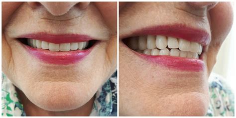 Precision Complete Upper And Lower Dentures Kelowna Denture Clinic