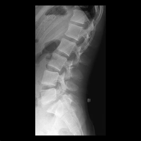 Pediatric Spondylolisthesis Pediatric Radiology Reference Article