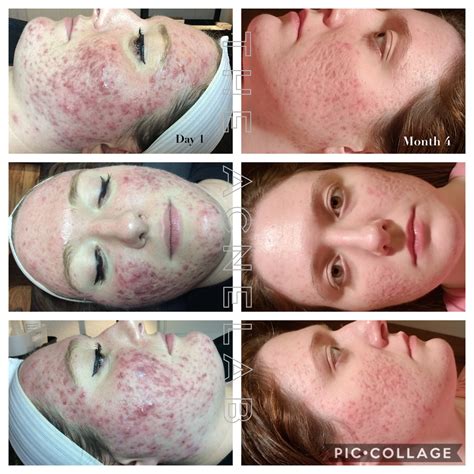 Cystic Acne — The Acne Lab