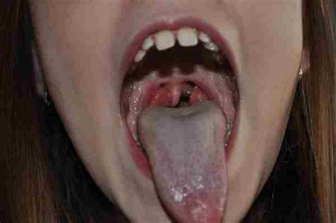 How Many Sets Of Tonsils Do You Have Sore Throat No White