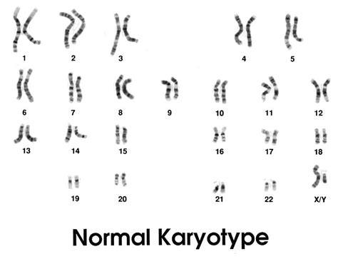 Difference Between Normal And Abnormal Karyotype Normal Vs Abnormal