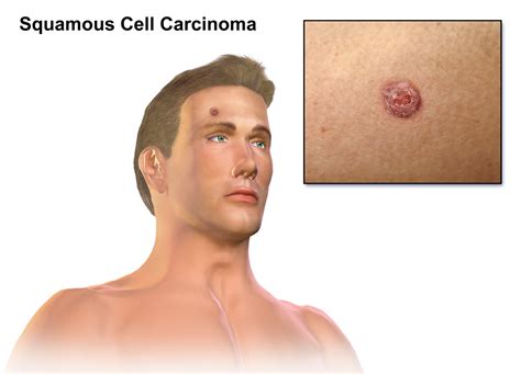 Squamous Cell Carcinoma Of Skin