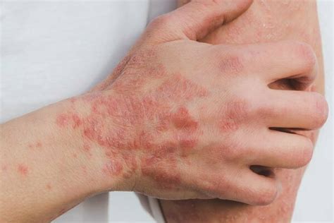 Common Chronic Skin Conditions