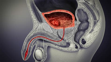 Bladder Cancer Types Symptoms Causes And Treatment Sa
