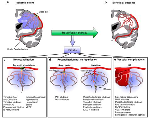 A hemorrhagic stroke happens when an artery in the brain leaks blood or ruptures (breaks open). IJMS | Free Full-Text | Improving Cerebral Blood Flow ...