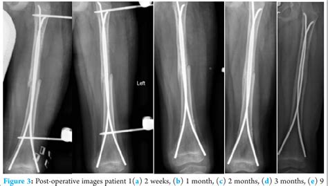 Figure 5 From Unstable Pediatric Femur Fractures Combined