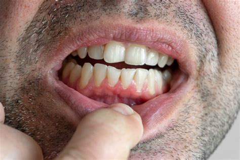 Causas Y Consecuencias Del Desgaste Dental Cka Grupo Dental
