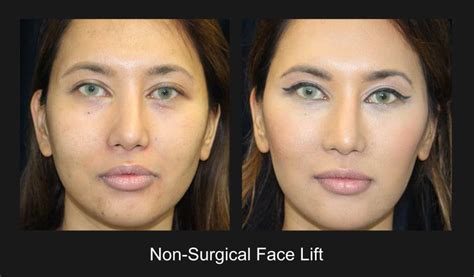 Non Surgical Face Lift Before And After Beverly Hills