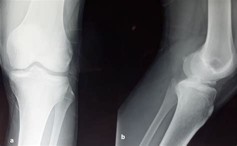 Avulsion Fracture Posterior Tibial Plateau