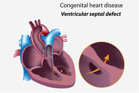 6 Types Of Congenital Heart Disease In Children And Treatment
