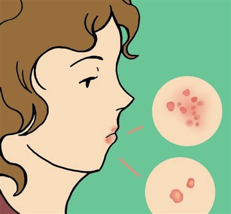 Everything About Cold Sores What Are They What Causes Them And How