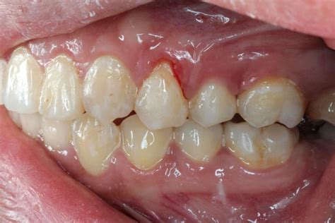Gum Recession Causes Treatment Prevention And More