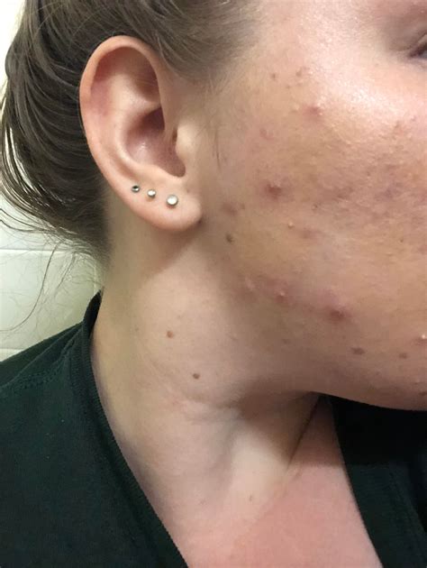 Any Skincare Recommendations For Cystic Acne This Is What They Looked
