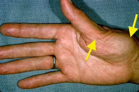 Osteoarthritis Carpometacarpal Cmc Joint Of Thumb Hand Surgery Source
