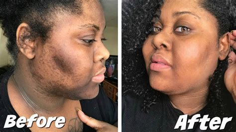 How To Get Rid Dark Scars Hyperpigmentation Youtube