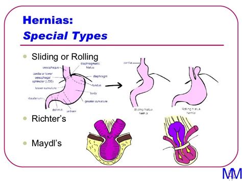 004 Hernias Introduction To Clinical Surgery Lectures