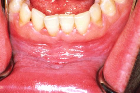Leucoplasia Oral Causas Síntomas Tratamientos Y Más