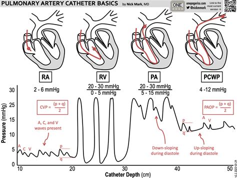 Swan Ganz Pulmonary Artery Catheter Basics Nick Grepmed