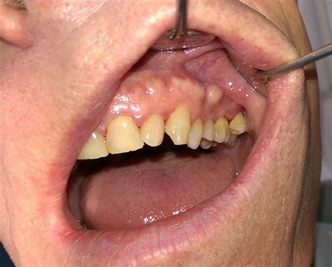 Circumvallate Papillae Side Of Tongue