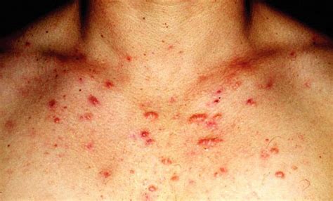 Ways To Get Rid Of Chest Acne Chest Acne Remedies
